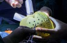 Алматыда ер адамға жасанды жүрек салынды