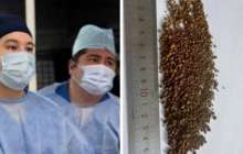 Алматылық дәрігерлер науқастың өт қабынан 5 499 тас алған