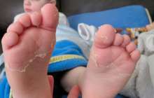 Қазақстанда Кавасаки синдромы бар екі бала көз жұмды