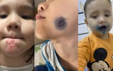 Балалардың беті мен денесіне біртүрлі жара шығып жатыр: беймәлім вирус шыққаны рас па