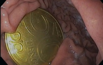 «Ата-анасы өзі түсіп қалады деп ойлаған»: Ақтауда бес жасар бала 50 теңгелік тиынды жұтып алып, үш күн жүрген (ФОТО)