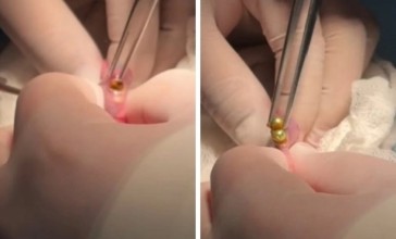 Шымкентте дәрігерлер үш жасар баланың асқазанынан 16 магнит алып шықты