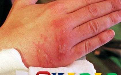 Күйік шалғандағы халық емі