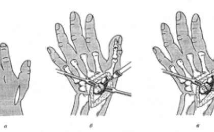 Галеация зақымдануы | KazMedic