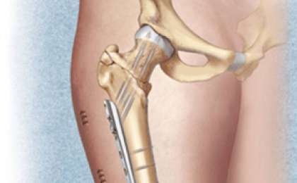 Сан диафизі сынықтары. | KazMedic