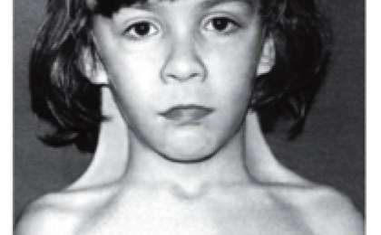 Хромосоманың Х моносомия синдромы (Шершевский-Тернер синдромы, Тернер синдромы,ХО- синдромы)