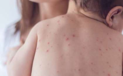 Денсаулық сақтау министрлігі қызылша ауруының өршу себебін түсіндірді