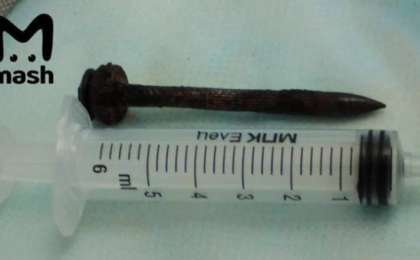 Ер адам басына кіріп кеткен шегемен екі жыл өмір сүрген