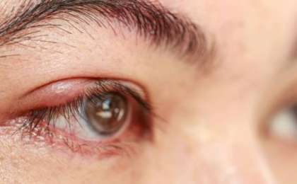 Теріскенді қалай емдеуге болады?