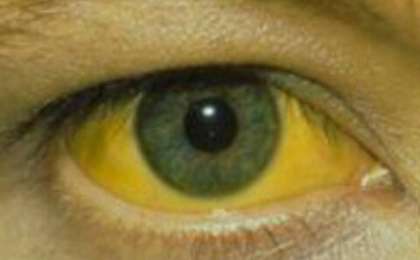 Сарыаурудан сауықтыру халық емі