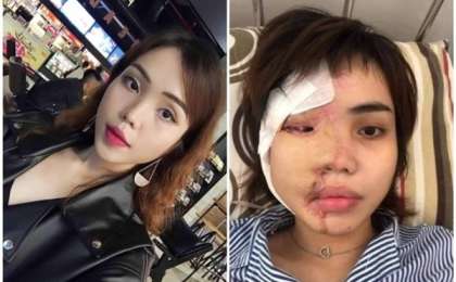 Қызғаншақ жігіт келіншегінің бетіне қышқыл құйып жіберген