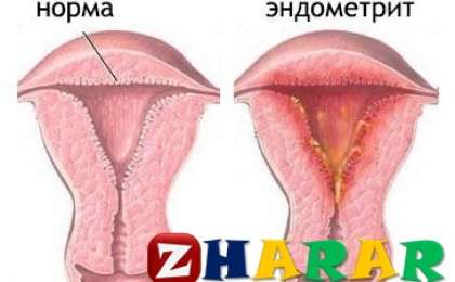 Эндометрит