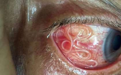 Дәрігерлер сәбидің көзінен 11 құрт алып шықты – жұрттың зәресін алған фото