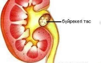 Бүйре қуық жолдарындағы тастан құтылу