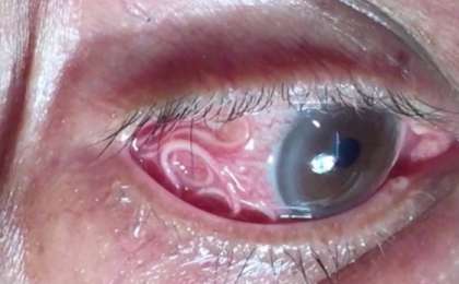 Ер адамның көзінен 15 сантиметрлік құрт шықты (ВИДЕО)