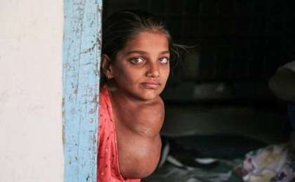 Бүлдіршіннің мойынына басындай көлемді ісік өскен