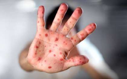 西哈州确诊麻疹病患人数82人