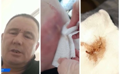 Қарағанды облысы тұрғыны отадан кейін ішінде қалып қойған дәкемен бір жыл жүрген