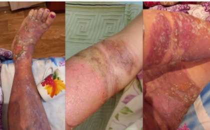 "Жедел жәрдем шақыруға рұқсат бермеген". Ақтөбеде ер адам әйелінің үстіне қайнаған су құйып жіберген