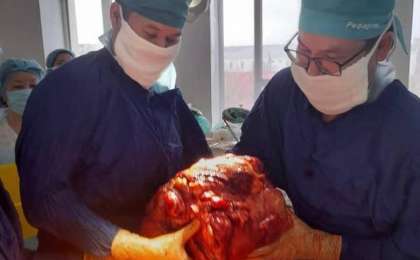 Атырау тұрғынынан дәрігерлер 15 келі ісік алды