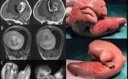 Қытайда бір жасар қыздың миынан егізінің ұрығы анықталды