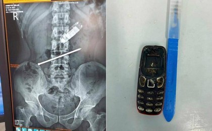 Дәрігерлер телефон жұтып қойған қызылордалық ер адамды құтқарып қалды