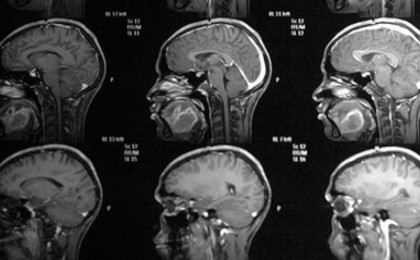 Онколог ми қатерлі ісігінің алғашқы белгілерін атады