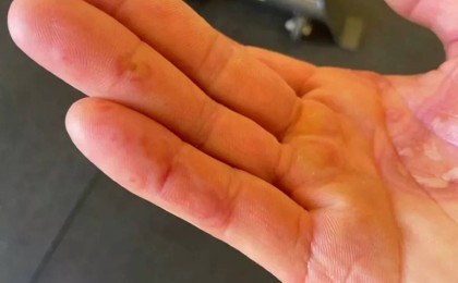 Қолдағы қызыл түйнек: Covid-19-дың жаңа симптомы анықталды