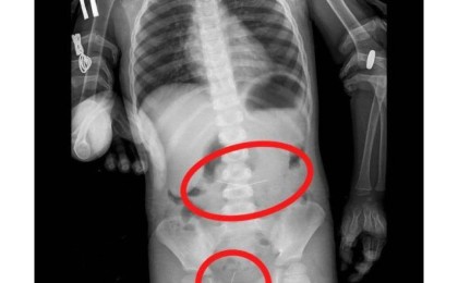 Үш жасар бала төрт тігін инесін жұтып қойған