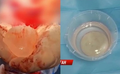 Семейде дәрігерлер бойжеткеннің миынан 7 сантиметрлік құрт алды