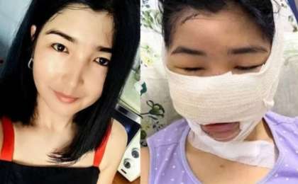 Мұрны мен құлағын кескен: күйеуінен зардап шеккен келіншекке ота жасалды