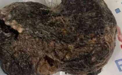 Жамбыл облысында бойжеткеннің асқазанынан 30 сантиметрлік тығыз шаш түйіні шықты