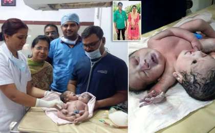 Үндістанда екі басты дені сау бала өмірге келді