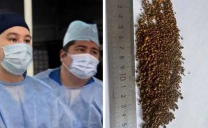 Алматылық дәрігерлер науқастың өт қабынан 5 499 тас алған