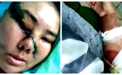 Түркістан облысында күйеуі балтамен ұрған әйелдің бір көзі соқырланып қалды - Қазақстан жаңалықтары