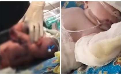 Семейдегі перзентханада дәрігерлер жаңа туған нәрестені күйдіріп алған