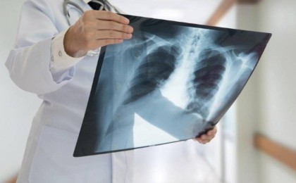 Қазақстанда COVID-19 белгілері бар пневмониямен 158 адам ауырып, 4 науқас көз жұмды