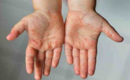 Министрлік Кавасаки синдромына шалдыққан балалар туралы айтты