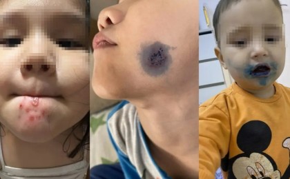 Балалардың беті мен денесіне біртүрлі жара шығып жатыр: беймәлім вирус шыққаны рас па