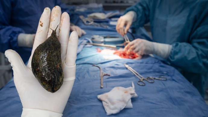 Түркістанда дәрігерлер жасөспірім қыздың асқазанынан 1 келіге жуық шаш түйінін алды