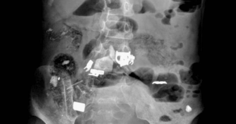 Қыз баланың ішінен шаш, қалам, темір және скточ шықты