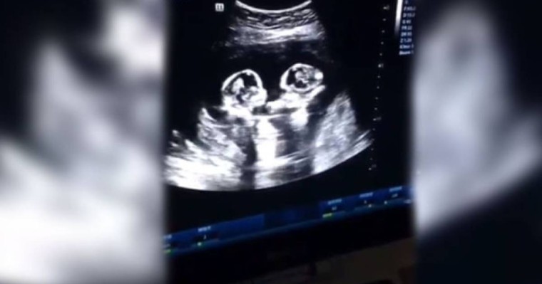 Құрсақта жатқан егіздер "төбелесті" - видео