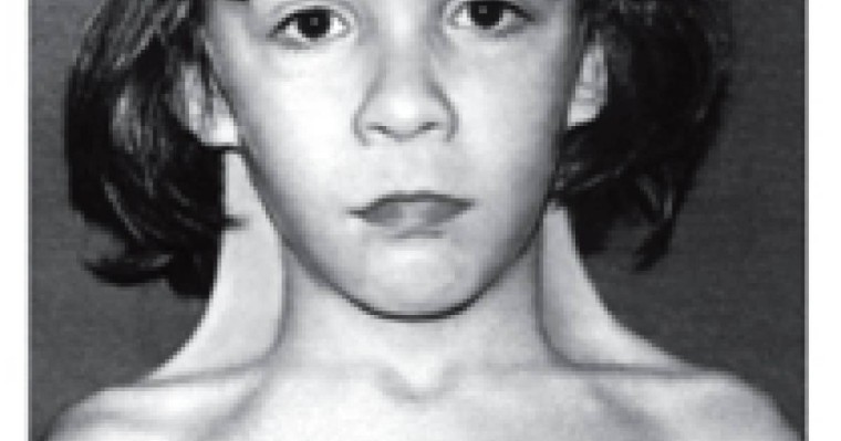 Хромосоманың Х моносомия синдромы (Шершевский-Тернер синдромы, Тернер синдромы,ХО- синдромы)