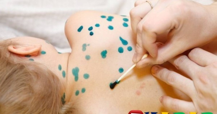 Шешекпен ауырған баланы емдеудің жолдары