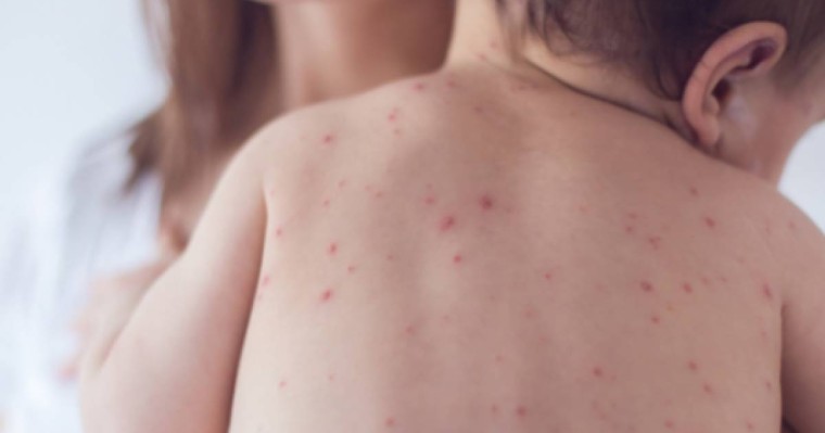 Денсаулық сақтау министрлігі қызылша ауруының өршу себебін түсіндірді