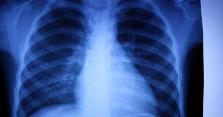 Астанадағы туберкулезге ұшырағандардың көбісі жалға пәтер алып тұратындар