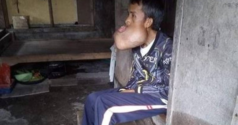 ФОТО: Ер адамның аузына басынан үлкен ісік өскен