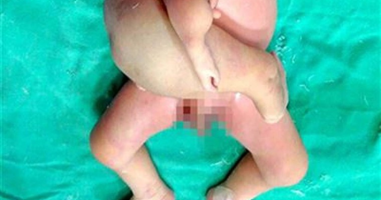 Ұзаққа созылған ота: нәрестенің беріш-егізі кесіп алынды