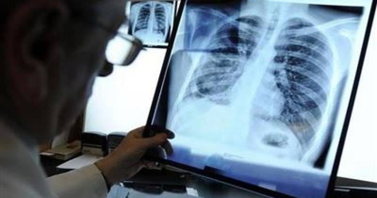 Туберкулездің қауіпті түрімен ауыратын 6 адам іздестіріліп жатыр