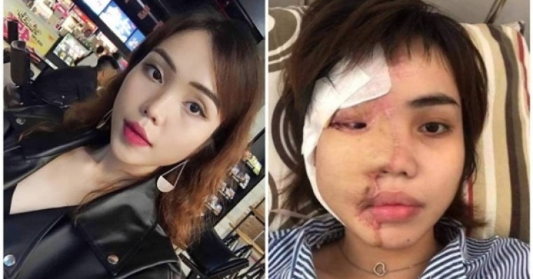 Қызғаншақ жігіт келіншегінің бетіне қышқыл құйып жіберген